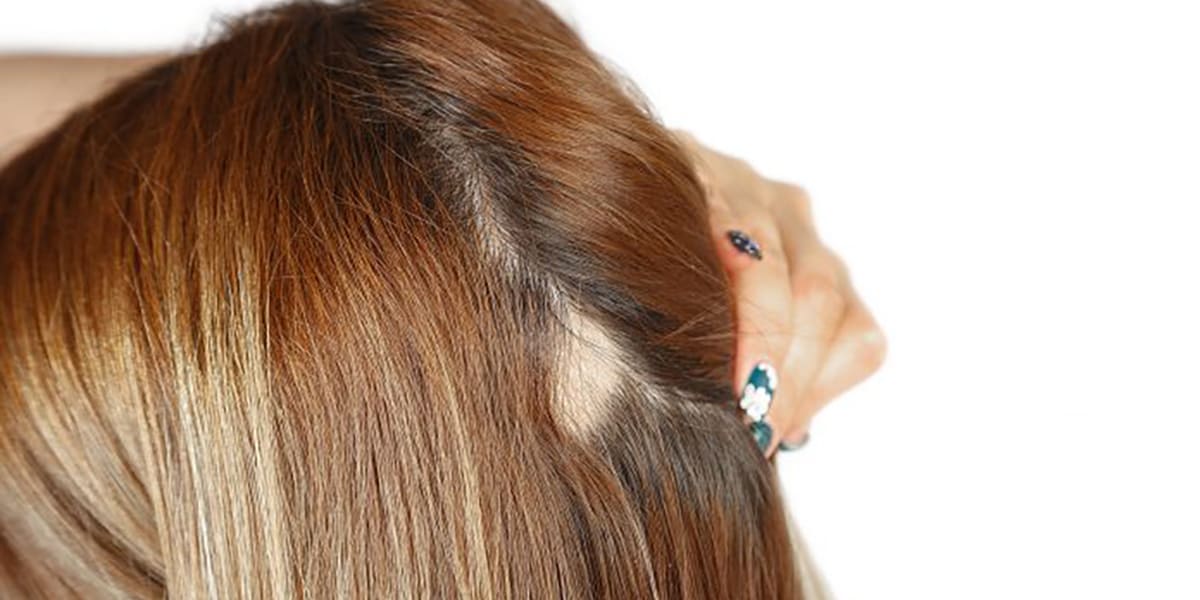 Alopecia: Nuestra selección de pelucas adecuadas para ti